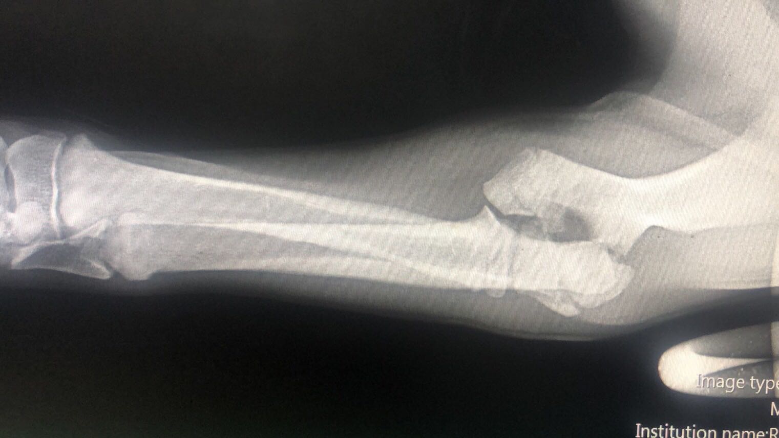 第五节 肘膝踝等关节的X 线影像改变图释
